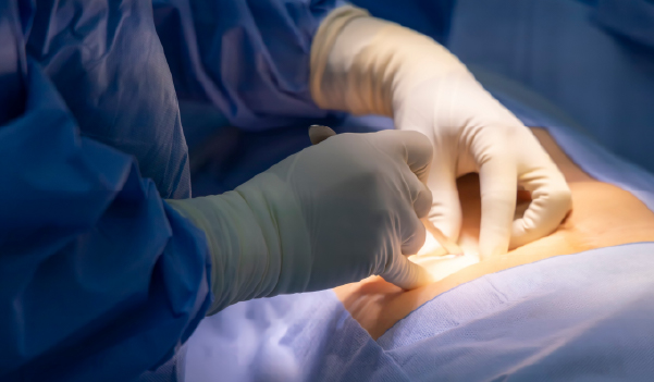 Appendix Surgery